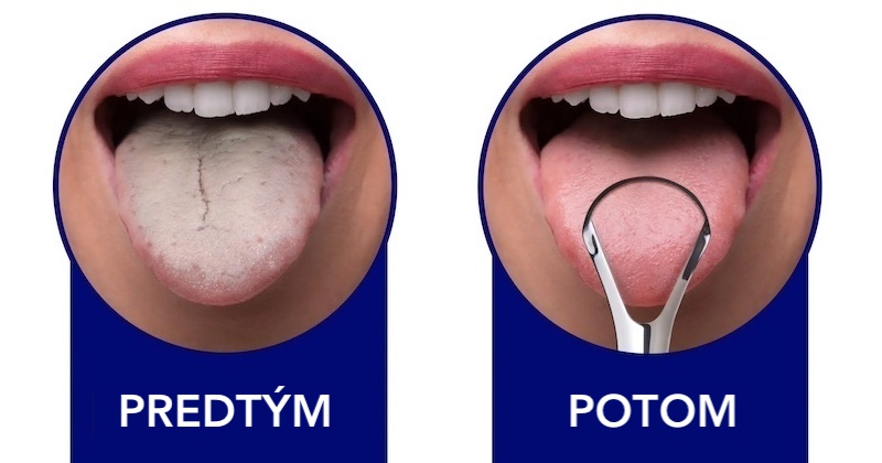 Skryté zdravotné prínosy starovekého rituálu: Ako zoškrabovanie jazyka podporuje kardiovaskulárne zdravie Skryté zdravotné prínosy starovekého rituálu: Ako zoškrabovanie jazyka podporuje kardiovaskulárne zdravie