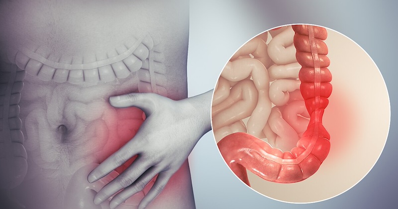 Vitamín, ktorý upokojuje hyperaktívny imunitný systém pri chronických ochoreniach čriev