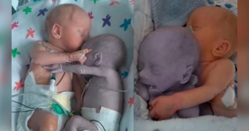 Zdravotná sestra položila zdravé novorodeniatko vedľa svojej umierajúcej sestry-dvojičky. To, čo sa stalo potom, navždy zmenilo medicínu Zdravotná sestra položila zdravé novorodeniatko vedľa svojej umierajúcej sestry-dvojičky. To, čo sa stalo potom, navždy zmenilo medicínu